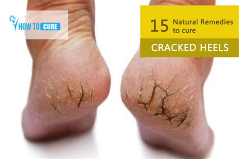 15 Natural Remedies To Cure Cracked Heels Cracked Heels Home Remedy