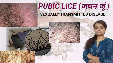 Pubic Lice Ll Cause Symptoms Prevention Treatment Ll Youtube
