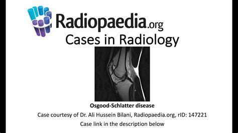 Osgood Schlatter Disease Cases In Radiology Youtube