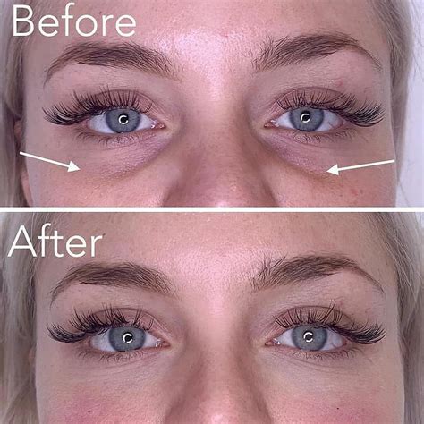 The Best In Cosmetics On Instagram Beforeafter Tear Trough Filler