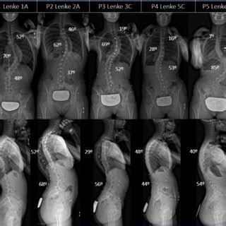 Preoperative Standing Posteroanterior And Lateral Radiographs Of Five