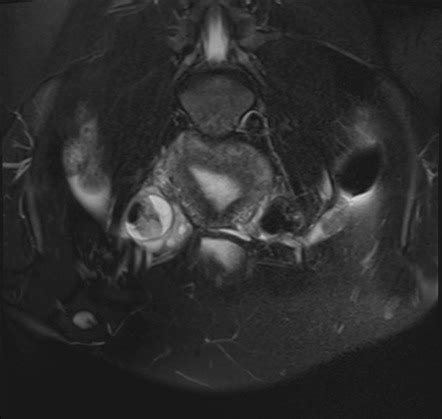 Mature Cystic Ovarian Teratoma Radiology Reference Article