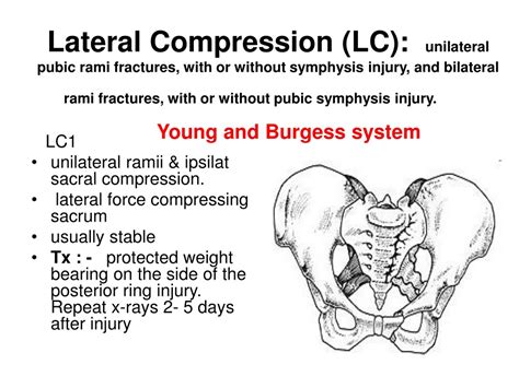 Ppt Pelvis Fracture Powerpoint Presentation Free Download Id9224056