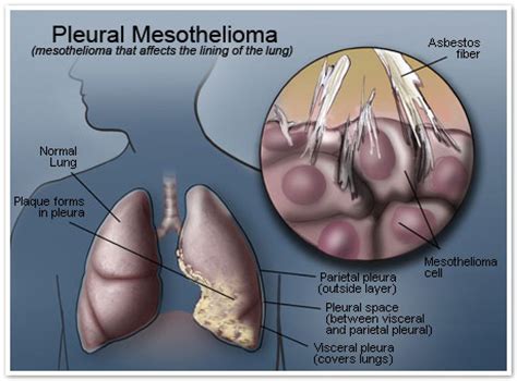 Although asbestos is banned in several countries, . Mesothelioma. Causes, symptoms, treatment Mesothelioma