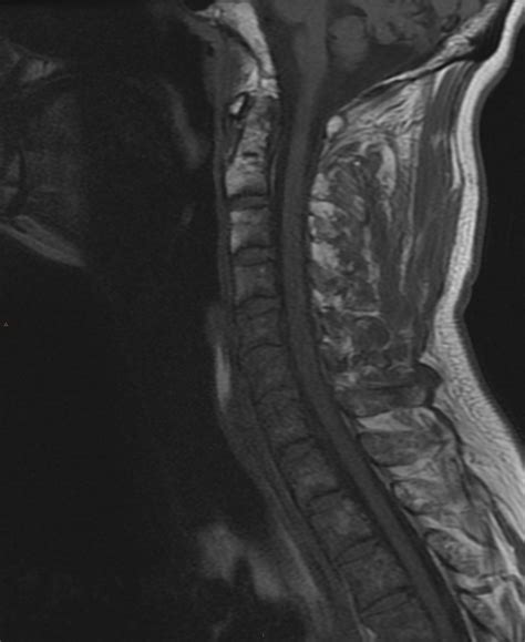 C6 Compression Fracture With Posterior Spinal Fractures And Cord