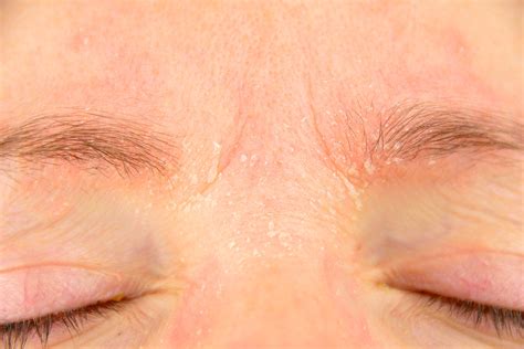 Treatments For Dry Skin Around Eyes Vargas Face And Skin Center