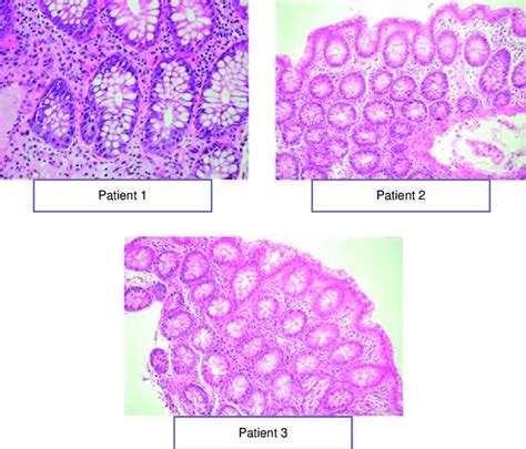 Histopathological Findings In Colon Specimens Obtained During