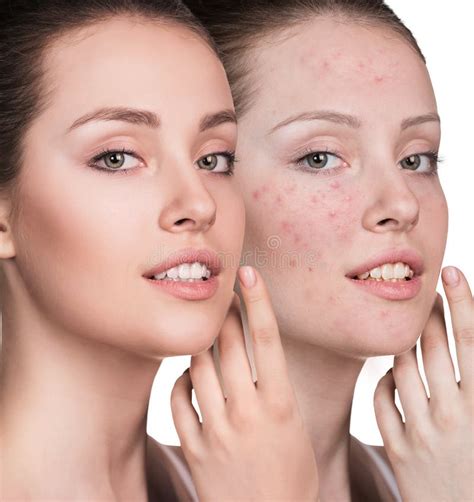 Woman With Problem Skin On Her Face Stock Image Image Of Makeup