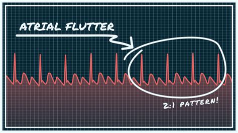 What Atrial Flutter Looks Like On Your Watch Ecg Qaly
