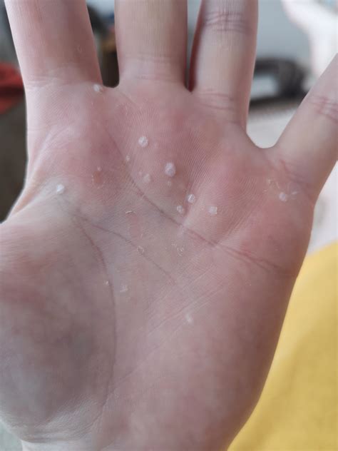 For Some Reason I Get Blisters On The Palm Of Only One Hand From