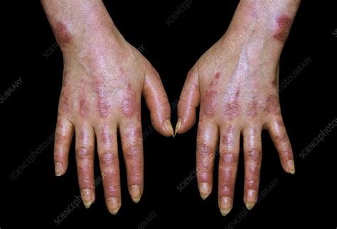 Lupus Erythematosus Stock Image C0443072 Science Photo Library