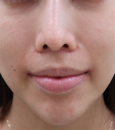 面長の症例には、上口唇 人中部から鼻翼基部までの白唇 短縮術と口角挙上術 ドクター森川ブログ