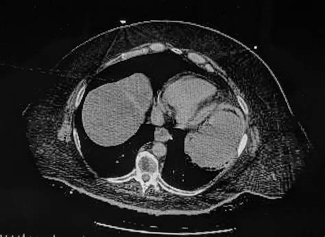 Ct Scan Of The Chest Abdomen And Pelvis Without Contrast Revealed A