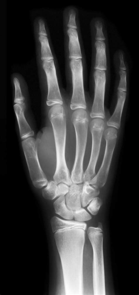 They just miss fewer findings. File:Hand-x-ray.jpg - Wikimedia Commons