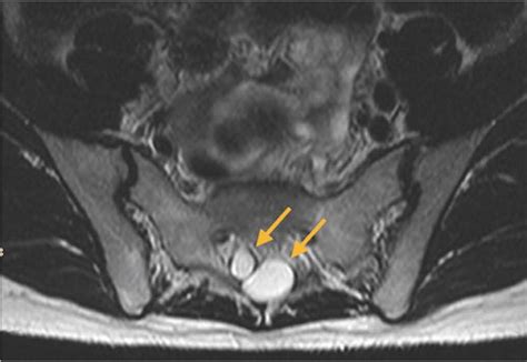 Tarlov Cysts In A Woman With Lumbar Pain Journal Of Orthopaedic