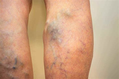 Ugly Leg Veins Treatments Causes Vein Clinic Perth