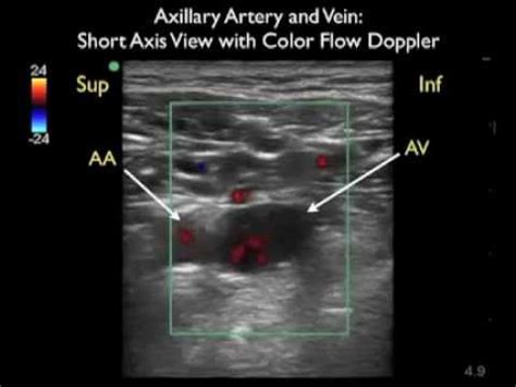 How To: Axillary Vein Cannulation - SonoSite Ultrasound.mp4 - YouTube