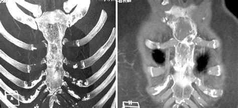 Computed Tomography Shows A Lytic Lesion Involving The Manubrium And