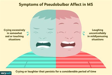 Pseudobulbar Affect In Ms Symptoms Diagnosis And Treatment
