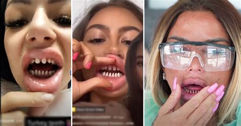 Dentist Warns Teeth Shaving Teens Theyll Need Dentures By Their 40s Small Joys