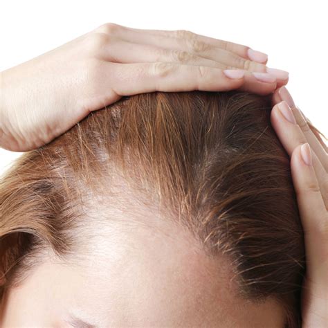 Share More Than 73 Female Hair Loss Causes Latest Ineteachers