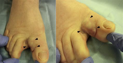 Endoscopic Stalk Resection Of A Toe Ganglion With Color Aided