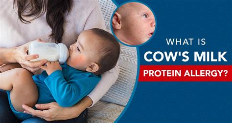Everything You Need To Know About Cows Milk Protein Allergy
