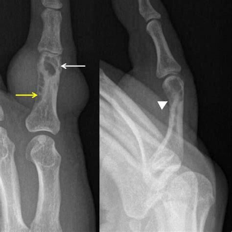 Pdf Tenosynovial Giant Cell Tumor Showing Severe Bone Erosion In The