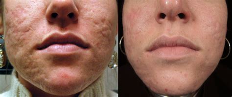 Scar Treatment Before And After Brian S Biesman Md