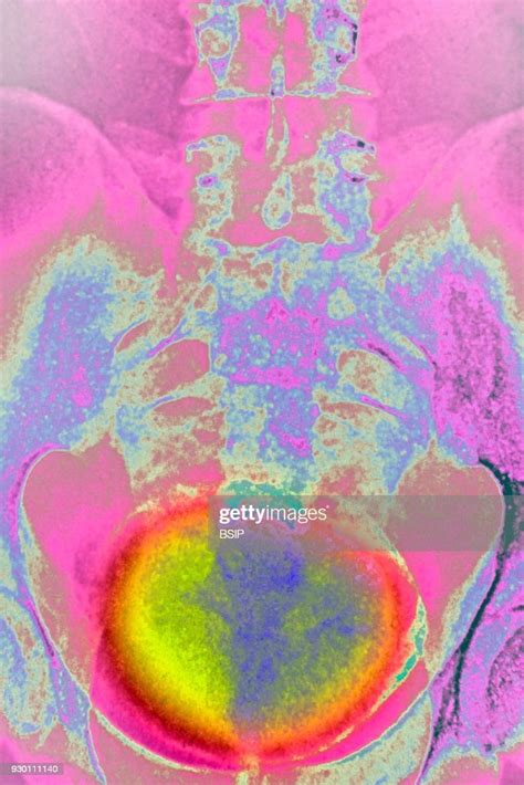 X Ray Of Urinary Schistosomiasis Frontal Pelvic X Ray News Photo