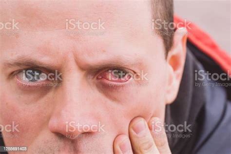 Broken Blood Vessel In Eye Man With The Subconjunctival Hemorrhage