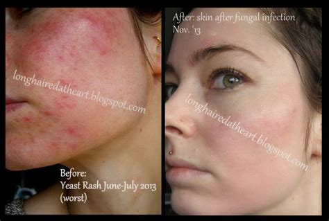 Acne From Yeast How My Skin Became Clear Again Long Haired At