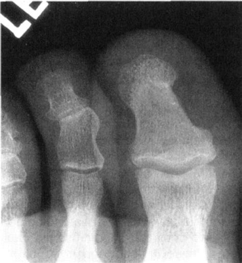 Avulsion Fracture Of The Great Toe A Case Report Andrew J Rapoff