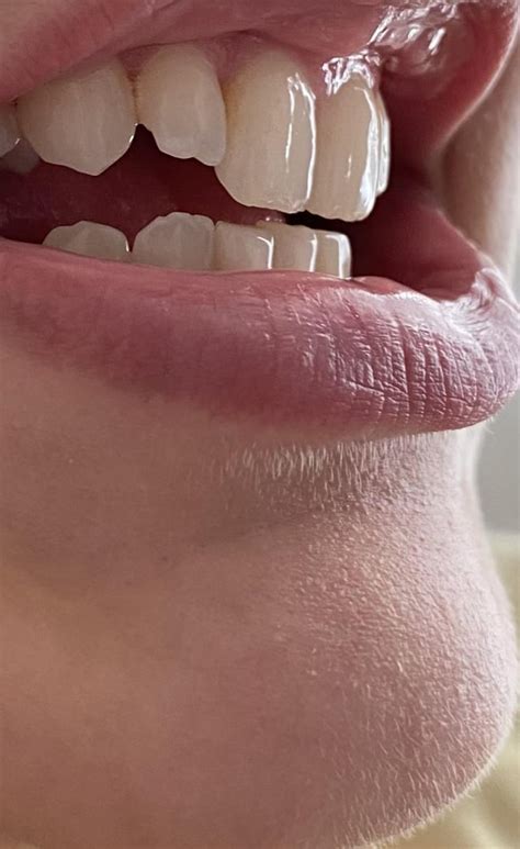 Lateral Incisors Crooked Rteethcare