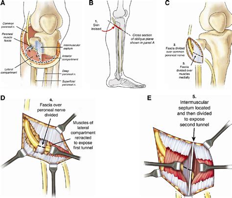 Paleys Technique 11 Of 2 Tunnel Peroneal Nerve Decompression Is Shown