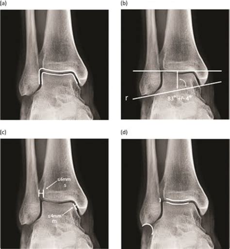 Chapter 21 Fractures And Dislocations Of The Ankle Musculoskeletal Key