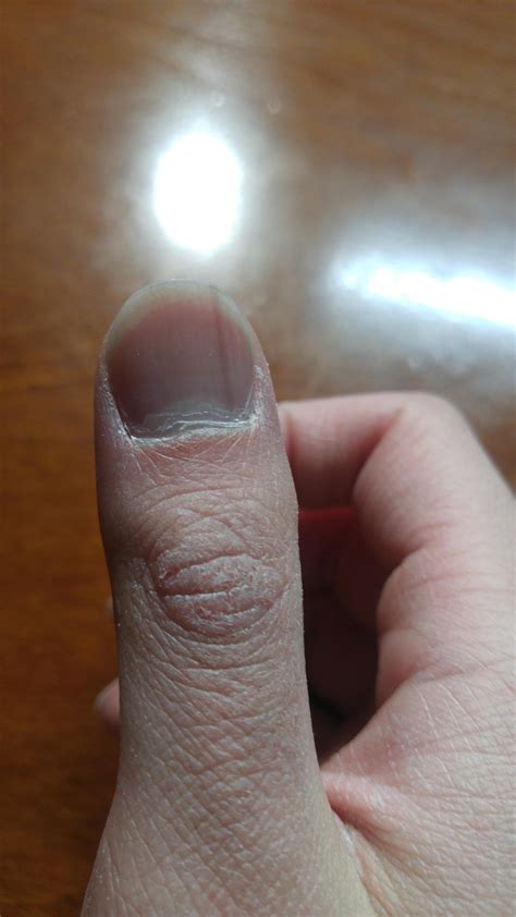 Faint Brown Line On My Right Thumb And Right Hand Is Dry Askdocs