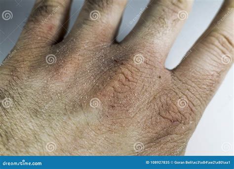 Close View Of Dry And Cracked Hand Knuckles Skin Problem Stock Image