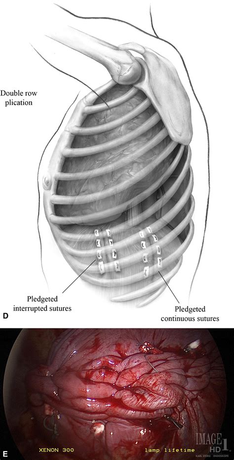 Technique Of Video Assisted Thoracoscopic Surgery Diaphragm Plication