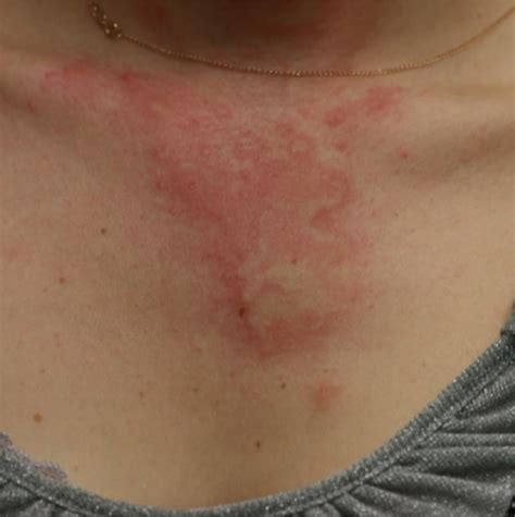 Hives On Neck And Face