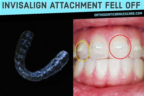 How To Clean Invisalign Attachments