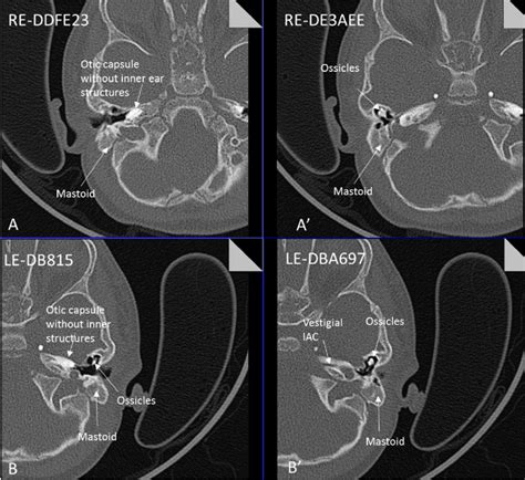 Axial Ct Petrous Bone In Patient 8 Of The Right Aa And Left Bb