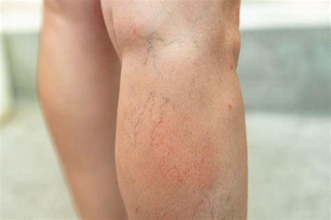 Tips For Varicose And Spider Veins Treatment Blog