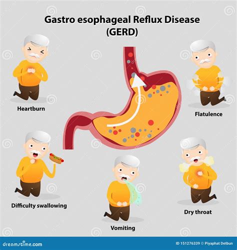 Gastro-Esophageal Reflux Disease GERD Stock Vector - Illustration of