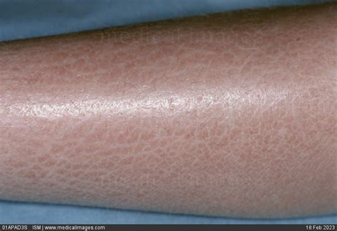 Stock Image Ichthyosis Of The Leg This Term Describes A Group Of