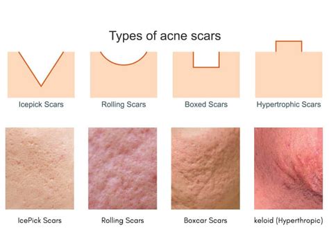 Acne Scar Removal In Singapore Cambridge Medical Group