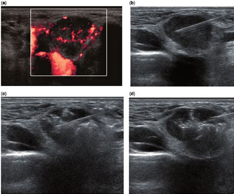 A Power Doppler Ultrasound Shows A Metastatic Node From Papillary