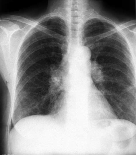 Chest X Ray Showing Bilateral Hilar Lymphadenopathy Together With Lower