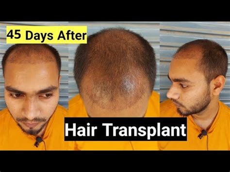 Review After Days Of My Hair Transplant Ganesh Thakur YouTube
