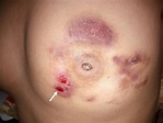 Cureus | Unusual Case of Bilateral Tubercular Mastitis